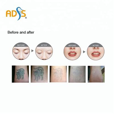 De Q Geschakelde Laser Pico Laser Tattoo Removal Machine 1064nm 532nm van Nd Yag